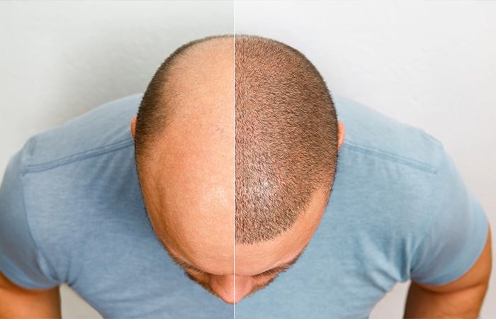 Hair Transplant